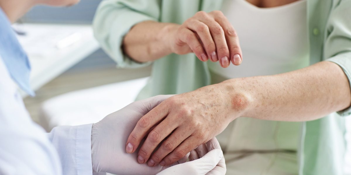 UCPel realiza aplicação pioneira de imunobiológico contra psoríase