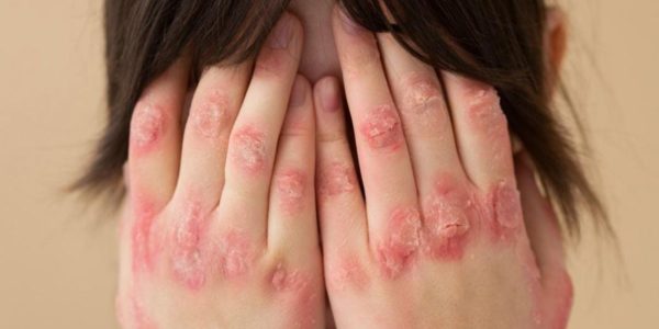 Lúpus atinge principalmente mulheres jovens e exige diagnóstico precoce para evitar danos aos órgãos